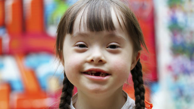 Down Syndrome adalah Gangguan Cacat Lahir. Kenali Ciri-Ciri dan Penyebabnya!