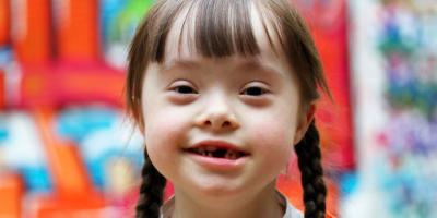 down syndrome, Penyebab Down Syndrome, Ciri-ciri Down Syndrome, Cara Mengatasi Down Syndrome